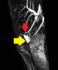 Percutaneous biloma drainage (Courtesy Dr. V. Penopoulos)