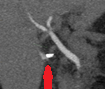 Percutaneous biloma drainage (Courtesy Dr. V. Penopoulos)