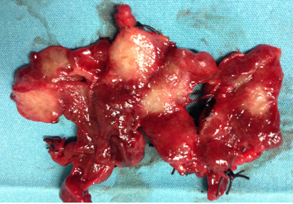Poorly differentiated thyroid carcinoma (Courtesy Dr. V. Penopoulos)