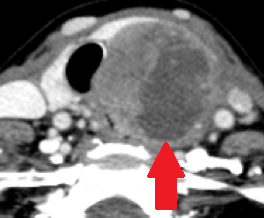 Neck CT. Poorly differentiated thyroid carcinoma (Courtesy Dr. V. Penopoulos)
