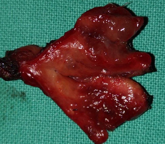 Total thyroidectomy surgical specimen (Courtesy Dr. V. Penopoulos)