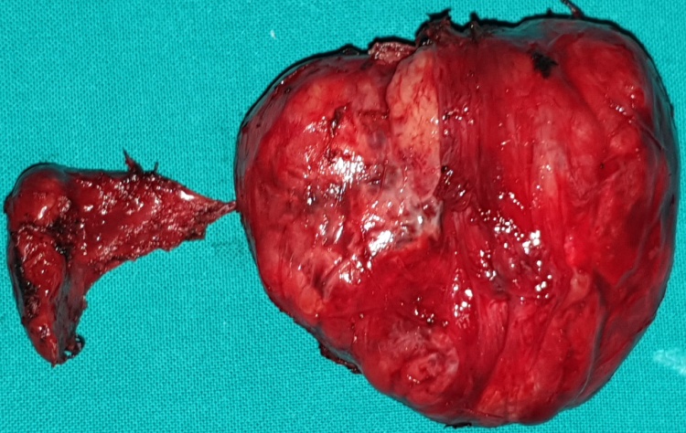 Total thyroidectomy surgical specimen (Courtesy Dr. V. Penopoulos)