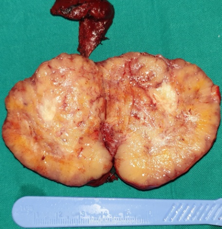 Total thyroidectomy surgical specimen (Courtesy Dr. V. Penopoulos)