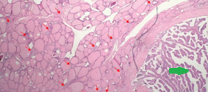 Poorly differentiated thyroid carcinoma (Courtesy Dr. V. Penopoulos)