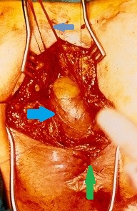 Μπλε βέλος — Άνω χείλος πρωκτοτομής. Κίτρινο βέλος — Νεόπλασμα ορθού (Ευγενική παραχώρηση Dr. V. Penopoulos)