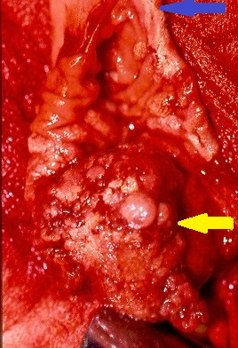 Μπλε βέλη — Κλείσιμο πρωκτοτομής (Ευγενική παραχώρηση Dr. V. Penopoulos)