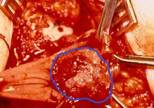 Εκτομαθέν παρασκεύασμα νεοπλάσματος ορθού (Ευγενική παραχώρηση Dr. V. Penopoulos)