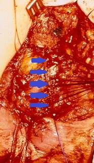 Αδενοκαρκίνωμα — Κοιλιοπερινεϊκή εκτομή ορθού. Κίτρινο βέλος — Εστία εκτομαθέντος νεοπλάσματος (Ευγενική παραχώρηση Dr. V. Penopoulos)