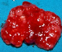 Αδενοκαρκίνωμα — Κοιλιοπερινεϊκή εκτομή ορθού. Κίτρινο βέλος — Εστία εκτομαθέντος νεοπλάσματος (Ευγενική παραχώρηση Dr. V. Penopoulos)