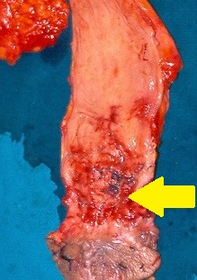 Αδενοκαρκίνωμα — Κοιλιοπερινεϊκή εκτομή ορθού. Κίτρινο βέλος — Εστία εκτομαθέντος νεοπλάσματος (Ευγενική παραχώρηση Dr. V. Penopoulos)