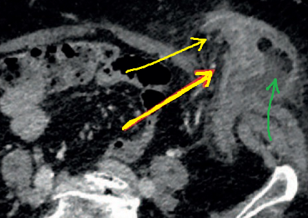 Κίτρινα βέλη — Φλεγμαίνουσες εκκολπώσεις στο εξω-κοιλιακό εντερικό τμήμα. Πράσινο βέλος — Υγρή συλλογή (Ευγενική παραχώρηση Dr. V. Penopoulos)