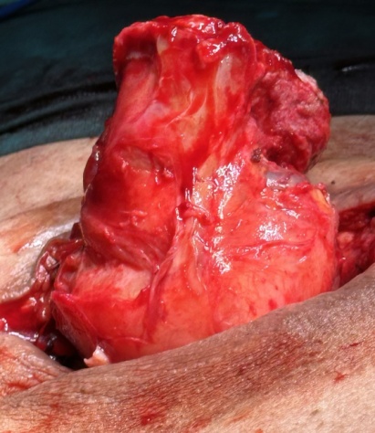 Κινητοποίηση τελικής κολοστομίας (Ευγενική παραχώρηση Dr. V. Penopoulos)