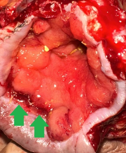 Φλεγμαίνοντα στόμια εκκολπώσεων (Ευγενική παραχώρηση Dr. V. Penopoulos)