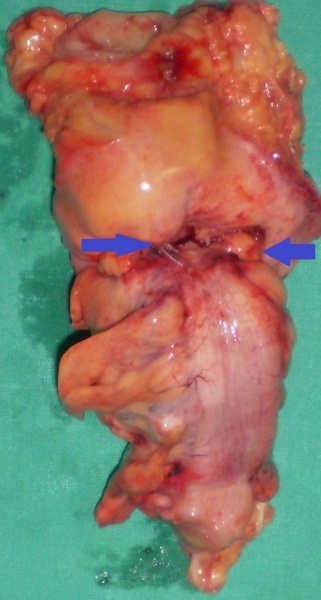 Εκτομαθέν τμήμα τελικής κολοστομίας. Μπλε βέλη — Θέσεις εκκολπώσεων (Ευγενική παραχώρηση Dr. V. Penopoulos)