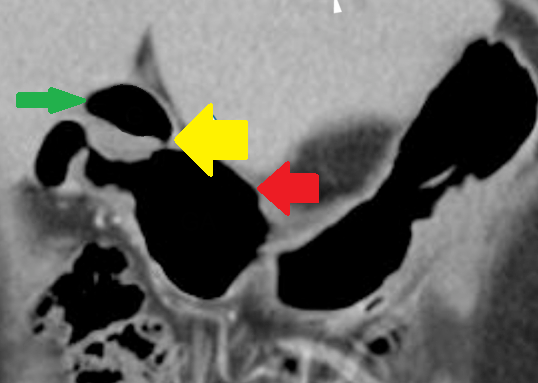 Yellow arrow — Thick-walled gallbladder with gallstones. Blue arrow — Stomach segment. Light blue arrows — Cholecystogastric fistula (Courtesy Dr. V. Penopoulos)