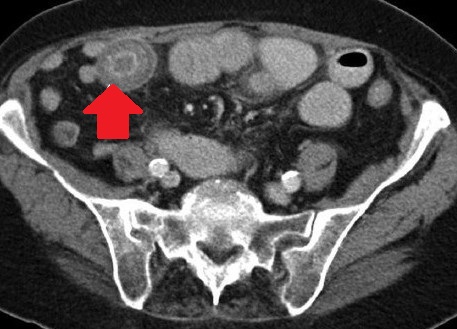 Yellow arrow — Thick-walled gallbladder with gallstones. Blue arrow — Stomach segment. Light blue arrows — Cholecystogastric fistula (Courtesy Dr. V. Penopoulos)