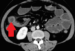 Yellow arrow — Thick-walled gallbladder with gallstones. Blue arrow — Stomach segment. Light blue arrows — Cholecystogastric fistula (Courtesy Dr. V. Penopoulos)