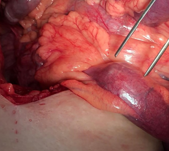 Yellow arrow — Thick-walled gallbladder with gallstones. Blue arrow — Stomach segment. Light blue arrows — Cholecystogastric fistula (Courtesy Dr. V. Penopoulos)