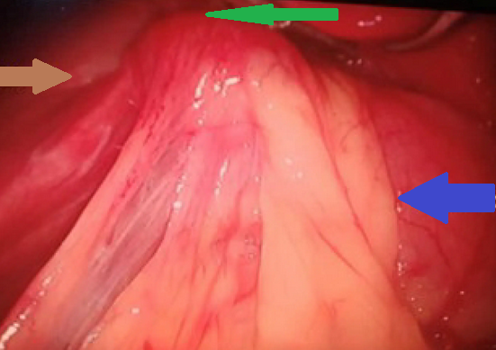 Yellow arrow — Thick-walled gallbladder with gallstones. Blue arrow — Stomach segment. Light blue arrows — Cholecystogastric fistula (Courtesy Dr. V. Penopoulos)