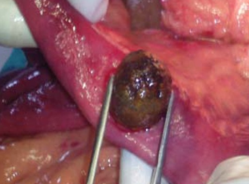Yellow arrow — Thick-walled gallbladder with gallstones. Blue arrow — Stomach segment. Light blue arrows — Cholecystogastric fistula (Courtesy Dr. V. Penopoulos)