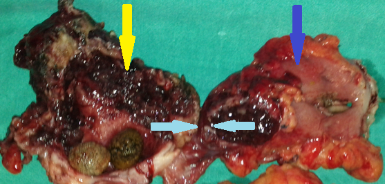 Yellow arrow — Thick-walled gallbladder with gallstones. Blue arrow — Stomach segment. Light blue arrows — Cholecystogastric fistula (Courtesy Dr. V. Penopoulos)