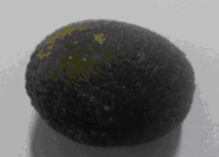 Yellow arrow — Thick-walled gallbladder with gallstones. Blue arrow — Stomach segment. Light blue arrows — Cholecystogastric fistula (Courtesy Dr. V. Penopoulos)