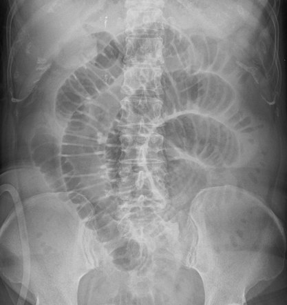 Plain abdominal radiographs. Small bowel loop distension. Red arrow — Radiopaque mass (gallstone) (Courtesy Dr. V. Penopoulos)
