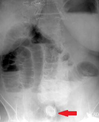 Gallstone in the ileum (Courtesy Dr. V. Penopoulos)