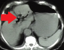Yellow arrow — Thick-walled gallbladder with gallstones. Blue arrow — Stomach segment. Light blue arrows — Cholecystogastric fistula (Courtesy Dr. V. Penopoulos)