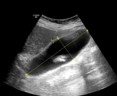Abdominal ultrasound — Cholelithiasis (Courtesy Dr. V. Penopoulos)
