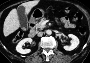 CT scan. Left-sided position of the gallbladder (Courtesy Dr. V. Penopoulos)