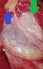 CT scan. Left-sided position of the gallbladder (Courtesy Dr. V. Penopoulos)