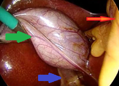 Red arrows — Anterior and posterior cystic arteries. Green arrow — Cystic duct (Courtesy Dr. V. Penopoulos)