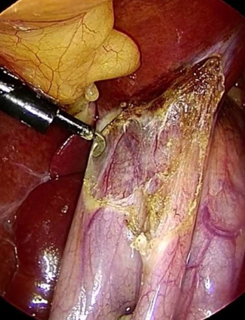 Red arrows — Anterior and posterior cystic arteries. Green arrow — Cystic duct (Courtesy Dr. V. Penopoulos)