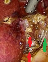 Red arrows — Anterior and posterior cystic arteries. Green arrow — Cystic duct (Courtesy Dr. V. Penopoulos)