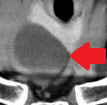Neck CT. Red arrow — Large cyst on the right, compressing the esophagus, with well-defined margins and colloid content (Courtesy Dr. V. Penopoulos)