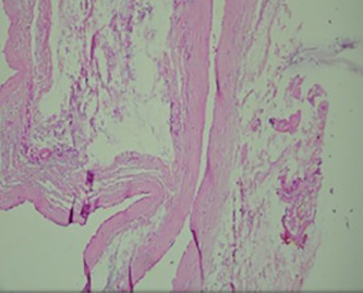 Fibrous cyst wall with flattened epithelium (Courtesy Dr. V. Penopoulos)