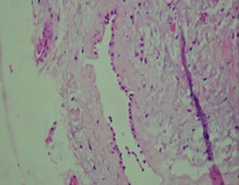 Parathyroid cells — Clear cells (Courtesy Dr. V. Penopoulos)