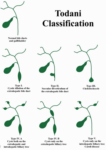 Dilated biliary duct lined by columnar epithelium (Courtesy Dr. V. Penopoulos)