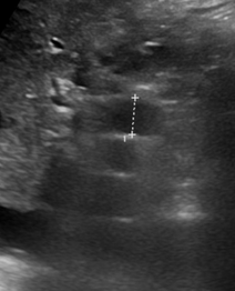 ERCP — Cystic dilatation of intrahepatic biliary duct (Courtesy Dr. V. Penopoulos)