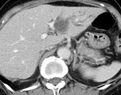 Percutaneous transhepatic cholangiography. Cystic dilatation of intrahepatic biliary duct with mucinous content (Courtesy Dr. V. Penopoulos)