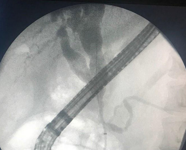 Green arrows — Cystic dilatation of intrahepatic biliary duct (Courtesy Dr. V. Penopoulos)