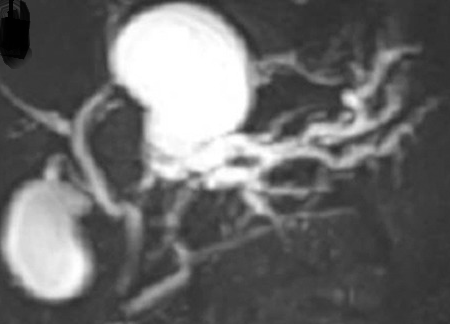 Dilated biliary duct lined by columnar epithelium (Courtesy Dr. V. Penopoulos)
