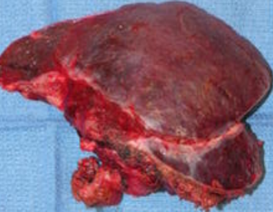 Dilated biliary duct lined by columnar epithelium (Courtesy Dr. V. Penopoulos)