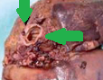Dilated biliary duct lined by columnar epithelium (Courtesy Dr. V. Penopoulos)