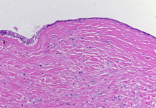 Dilated biliary duct lined by columnar epithelium (Courtesy Dr. V. Penopoulos)