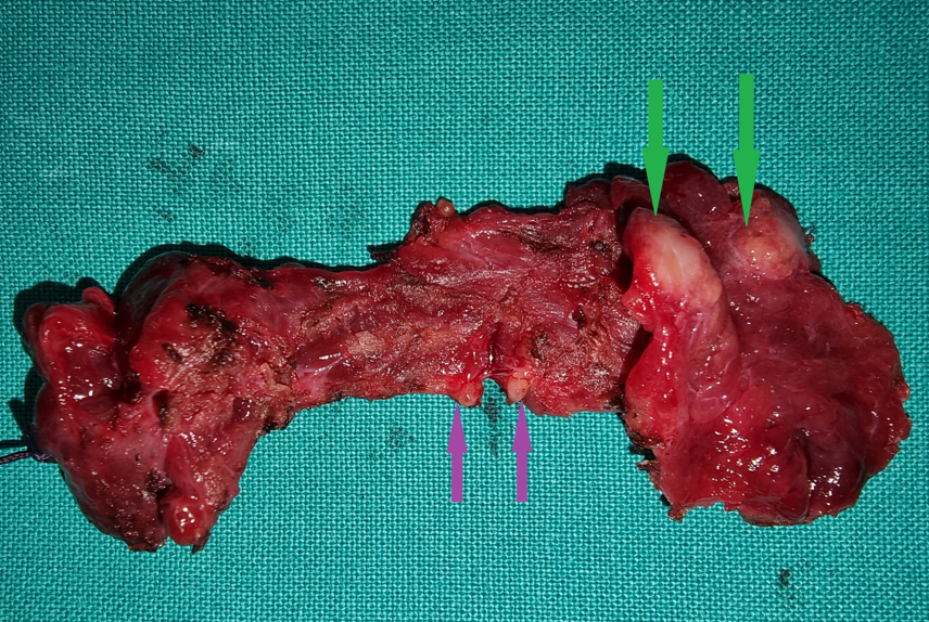 Total thyroidectomy surgical specimen. Green arrows — Papillary carcinoma. Purple arrows — Infiltrated microscopic lymph nodes of the isthmus (Courtesy Dr. V. Penopoulos)
