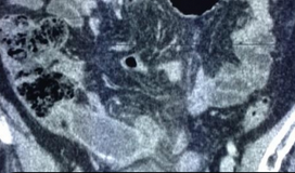 Υπερπλαστική βλεννοκήλη (Ευγενική παραχώρηση Dr. V. Penopoulos)