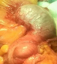 Υπερπλαστική βλεννοκήλη (Ευγενική παραχώρηση Dr. V. Penopoulos)