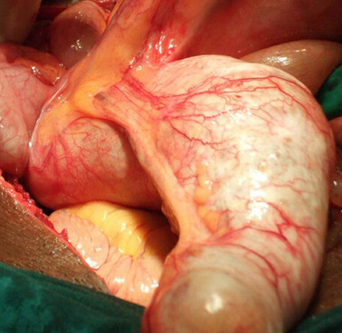 Βλεννώδες κυσταδένωμα (Ευγενική παραχώρηση Dr. V. Penopoulos)